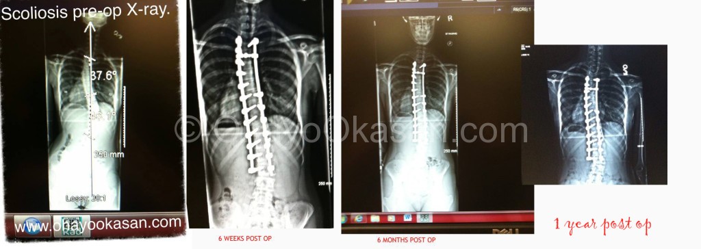 Scoliosis Xray pictures, before and after surgery
