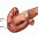  Zollinger-Ellison syndrome