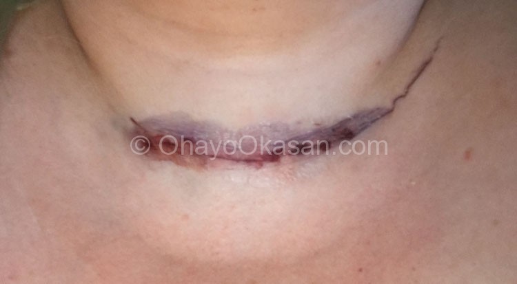 Thyroidectomy scar - removing my thyroid